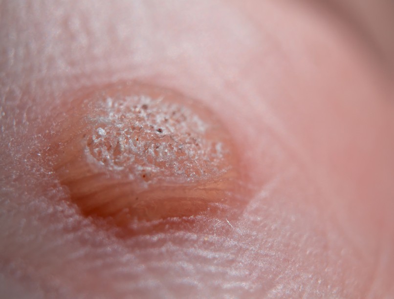 szemölcs, szemölcstípus, immunrendszer, szemölcs eltávolítása