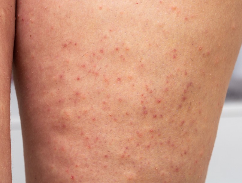 szőrtüszőgyulladás ellen kezelés otthon