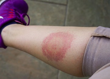 Lyme-kór: így zajlik a kullancsok által terjesztett betegség kezelése