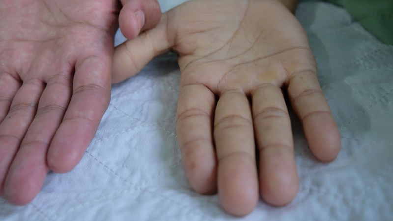 Megaloblasztos anémia tünetei, vizsgálata és kezelése