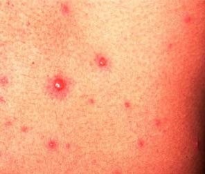 "Bárány és farkas" - a gyermek- és felnőttkori bárányhimlő