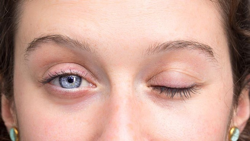 Mi a gyakori pislogás nystagmus