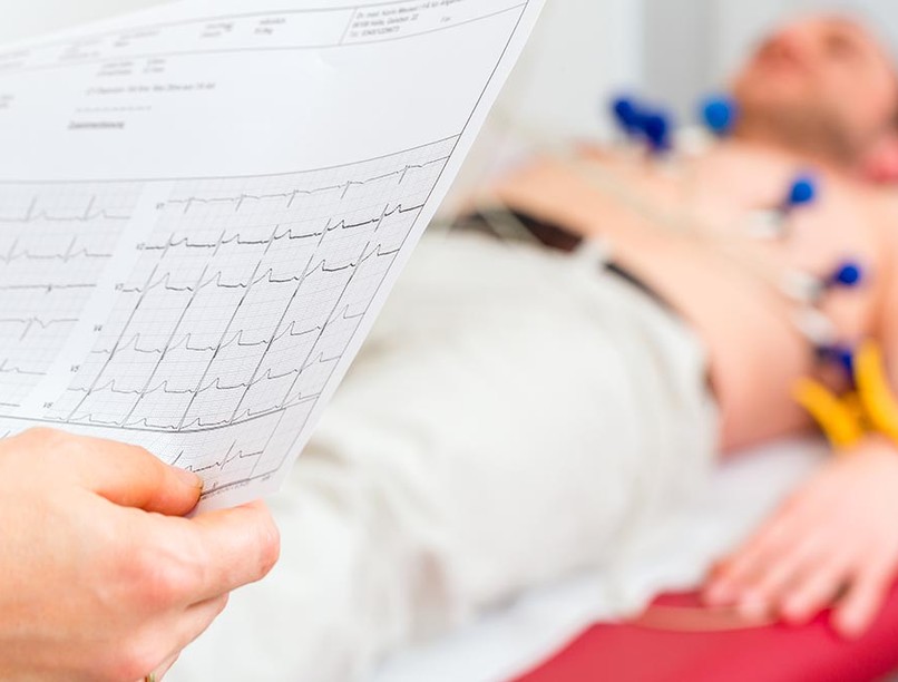 szívritmuszavar, EKG, szívinfarktus, dohányzás