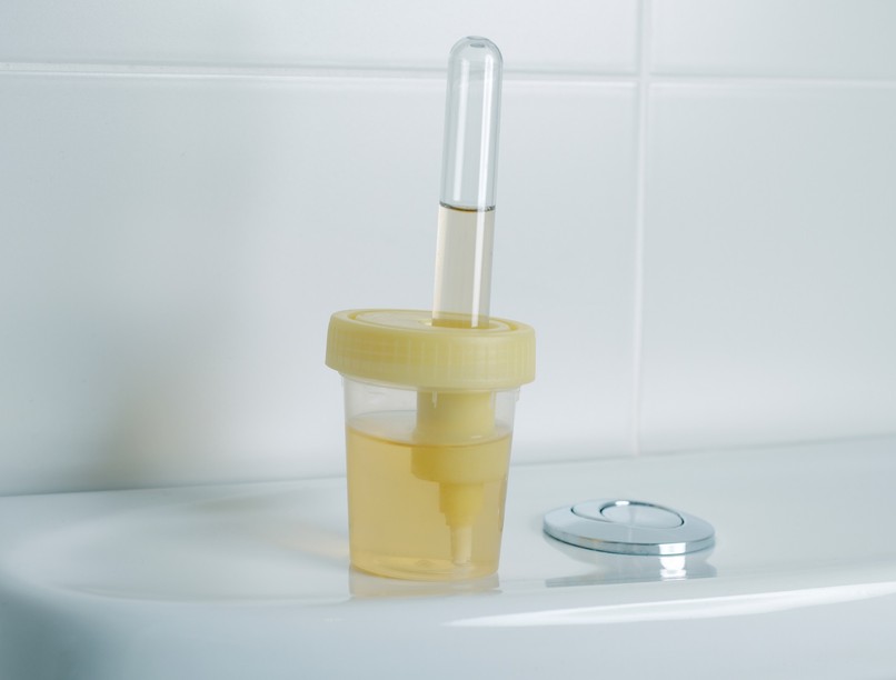 széklet vizelet színe megváltozik májbetegség