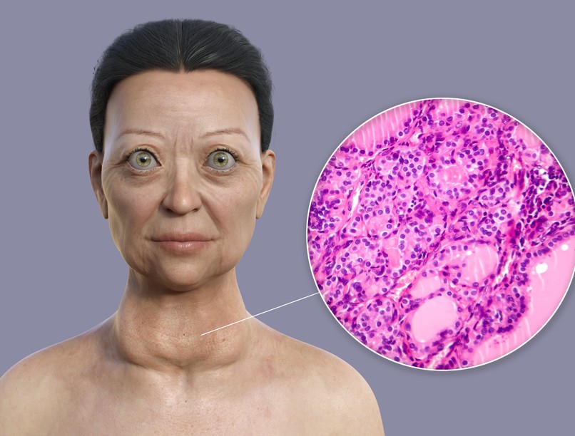 Basedow-kór tünet vizsgálat kezelés