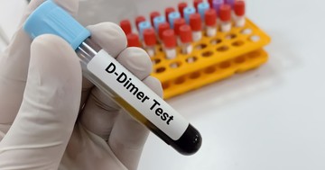  Mit jelent a D-dimer érték a laborleleten? 
