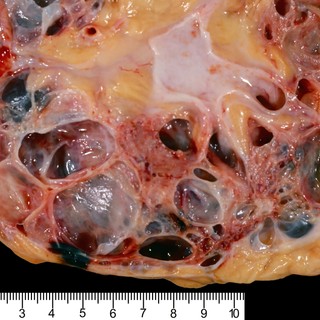 Policisztás vesebetegség tünetei, vizsgálata és kezelése című cikk nyitóképe