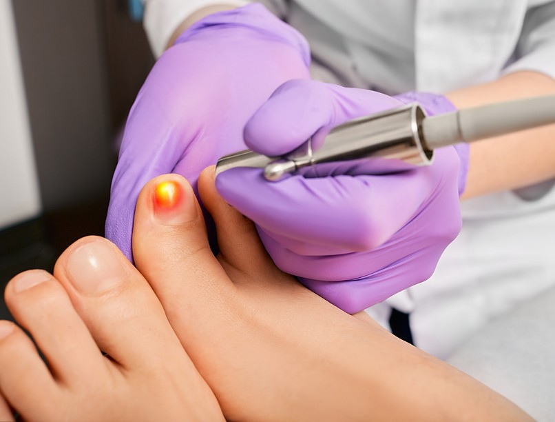 körömgomba lézerterápia fertőzés lábápolás