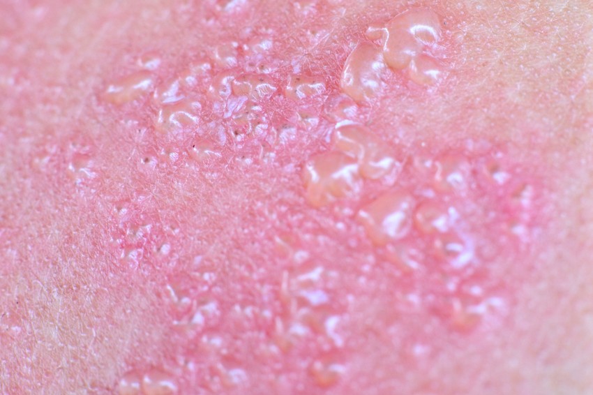 Jellemző bőrelváltozásai a bőrpír- és duzzanat, melyen apró, kezdetben víztiszta bennékű hólyagok jelennek meg. 