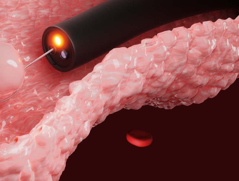 vastagbél, polip, betegség, vastagbélpolip orvos válaszol