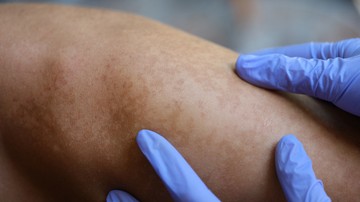 Nem mindegy, milyen típusú a pigmentfoltja - gyulladás is állhat a háttérben