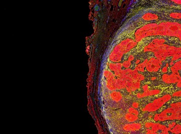 Hideg és forró tumorok: ettől függhet az immunterápiás rákkezelés hatásossága!