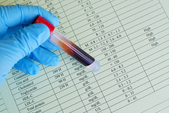 Mit jelent az LDL-koleszterin érték a laborleleten? című cikk nyitóképe