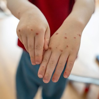 Járvány Ukrajnában: miért veszélyes a Coxsackie-vírus, és miről ismerhetők fel a tünetei? című cikk nyitóképe