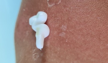 Ha legyengül a szervezete, nagyobb eséllyel támadják meg a bőrét ezek a gombák