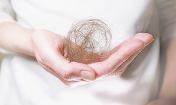 Kóros hajhullás: hormonzavar és stressz is okozhatja