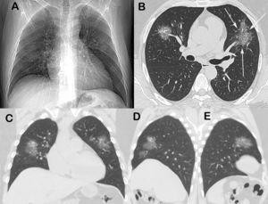 Koronavírus okozta tüdőgyulladás röntgenfelvétele (a fehér rész az érintett)