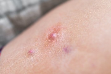 A hidradenitis suppurativa nem egy fertőző betegség, hanem a szőrtüszők autoimmun-gyulladásos állapota, amely során az immunrendszer a saját szőrtüszőit megtámadva alakít ki gyulladást, hegesedést a verejtékmirigyekkel borított területen.