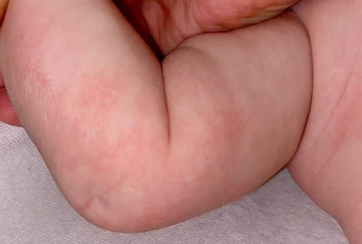 Ekcéma szerű, hámló kiütések baba karján