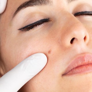 Eltávolítható az arcon lévő anyajegy hegesedés nélkül? című cikk nyitóképe