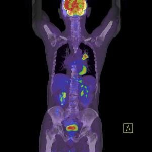 A PET/CT lényege