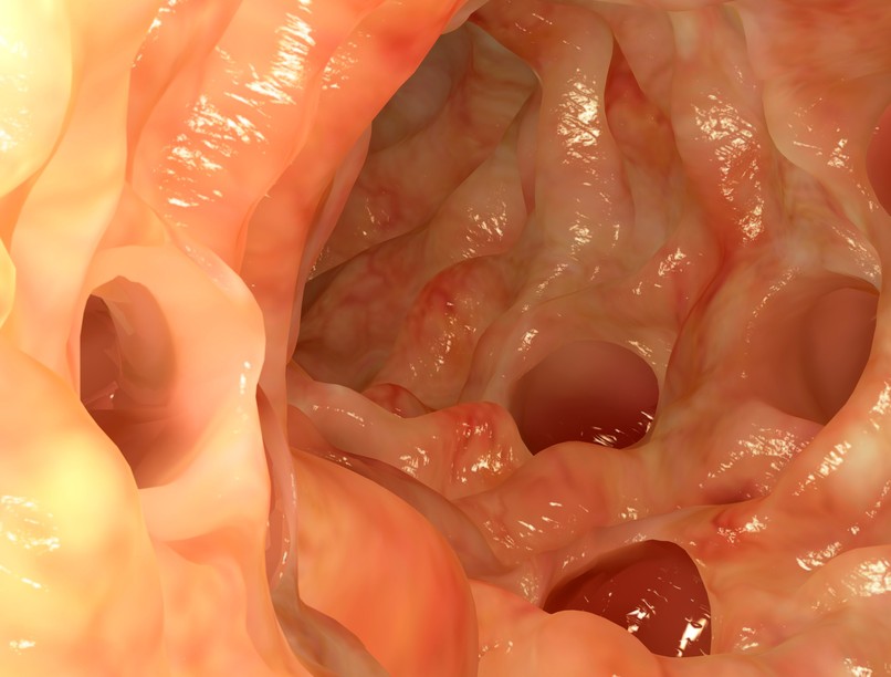 hogyan lehet a vastagbélpolipból vastagbélrák rosszindulatú daganat