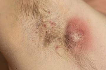 A HS rendszerint pattanásszerű dudorként kezdődik ott, ahol általában pattanás (acne) nem jellemző, ezért acne inversának is nevezik.