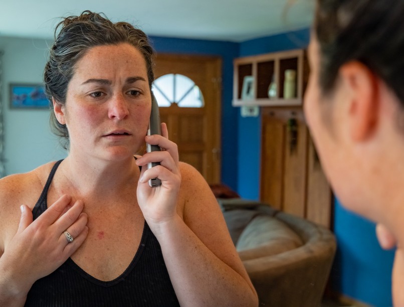 basalioma bőrrák, melanóma, tünet kinézet