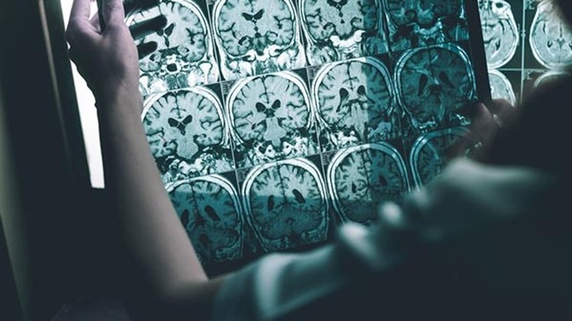 alzheimer-kor