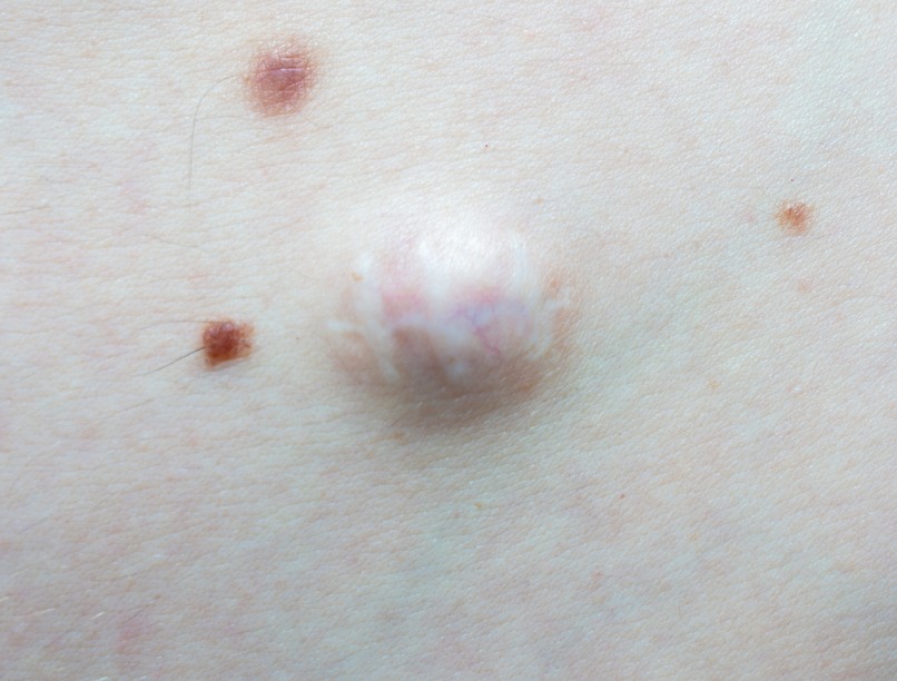 bőrkiütés, atheroma, zsirmirgy