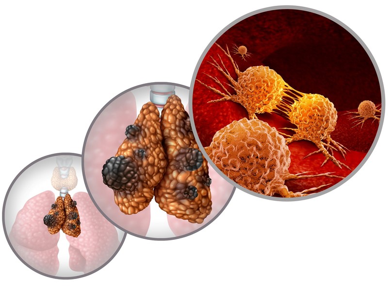 csecsemőmirigy thymus daganatos betegség rákbetegség immunrendszer