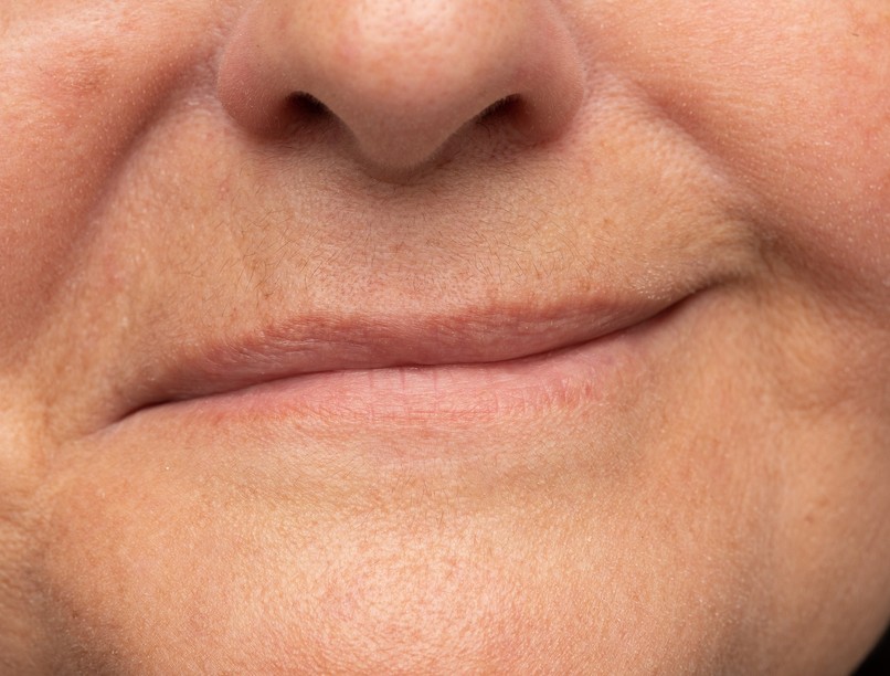 lefelé görbül száj jele arcidegbénulás korai tünet