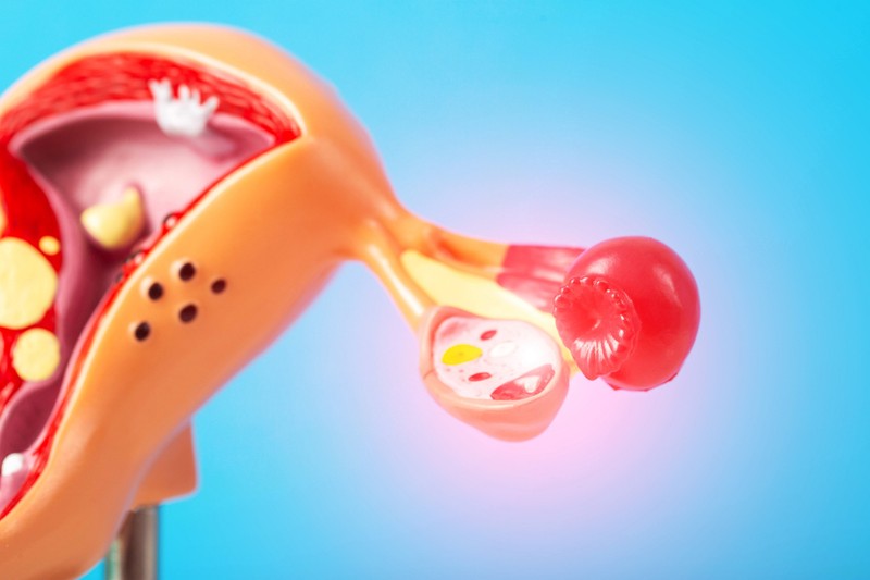 Petefészekrák-kezelés: így tehetné személyre szabottabbá a mesterséges intelligencia