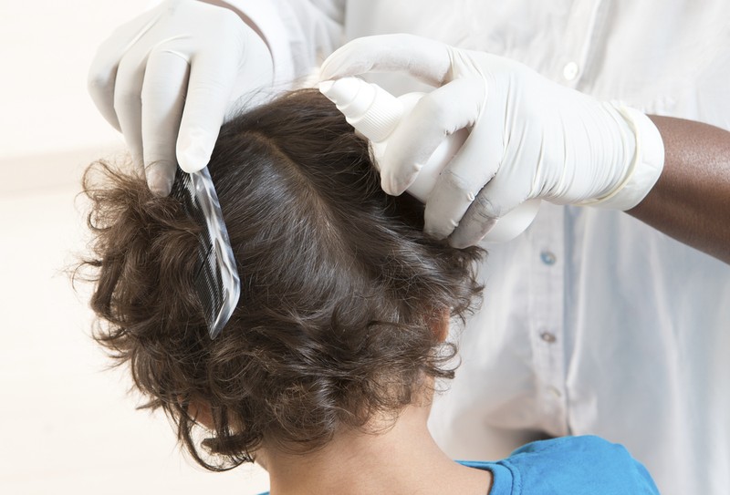 Fejtetű-fertőzés: tünetei, vizsgálata és kezelési lehetőségei