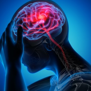 Stroke: a betegek harmada nem éli túl című cikk nyitóképe