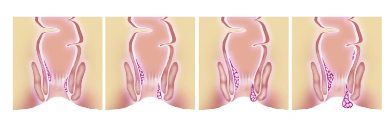 Íme az aranyér fokozatai: ismerjük fel a bajt és cselekedjünk időben!  (x)