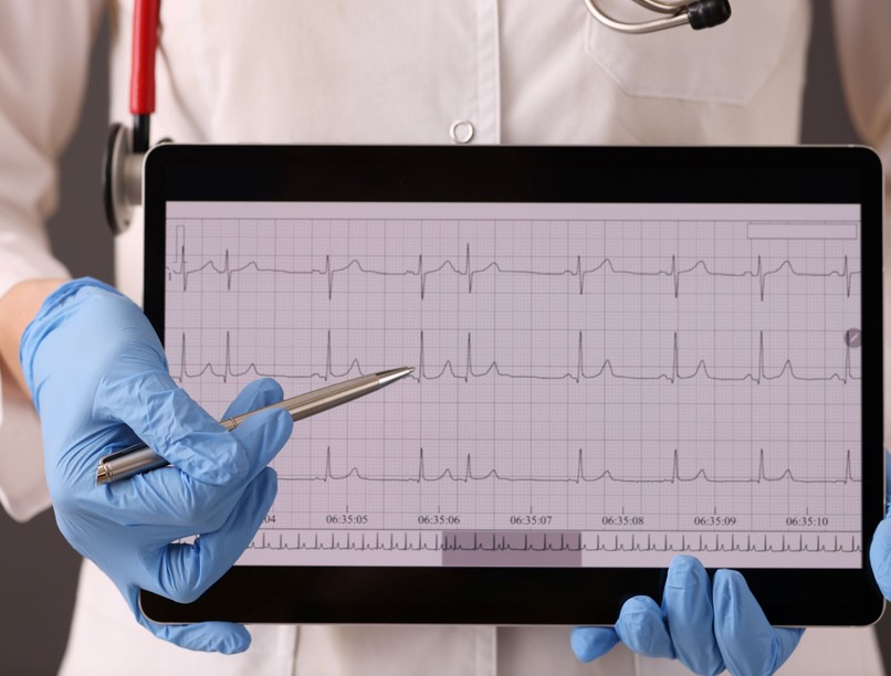 szívritmuszavar szívprobléma pitvarfibrilláció jele stroke tünete