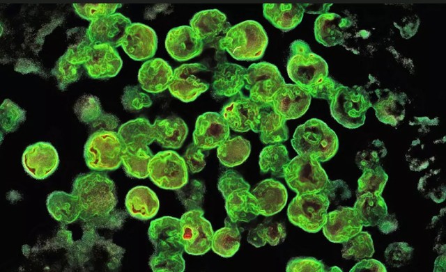 Egy amőba felfalta egy nő agyát, aki csapvízzel öblítette ki az orrmelléküregeit