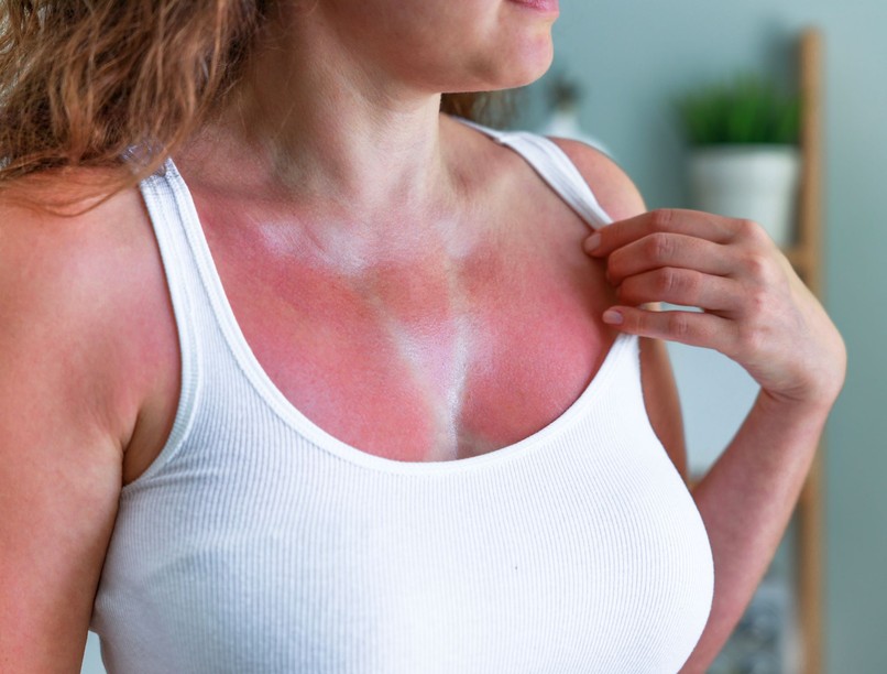 legjobb otthoni gyógymódok napégéses bőrre